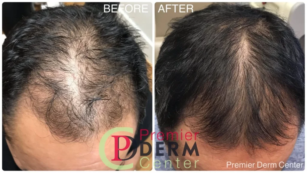 hair-restore ,Premier Derm Center PLLC | Houston, TX